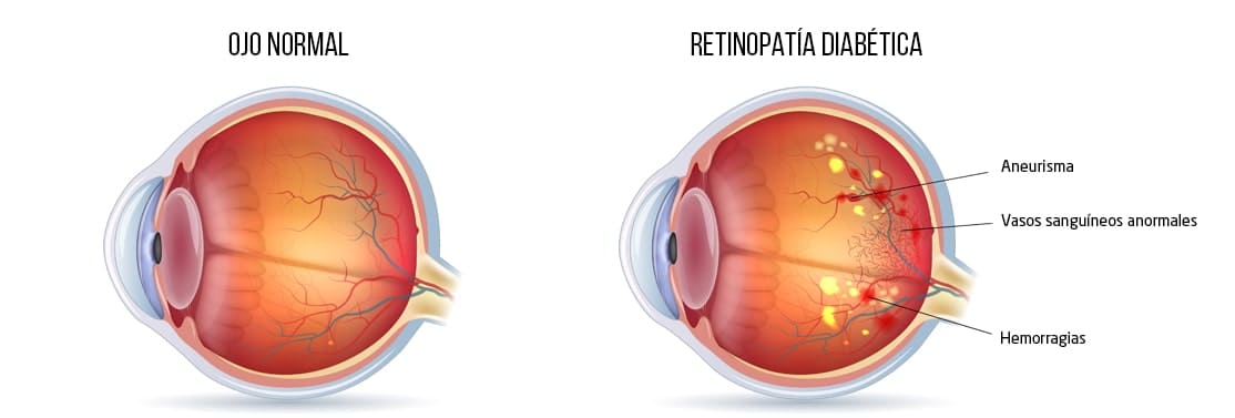 Retinopatía